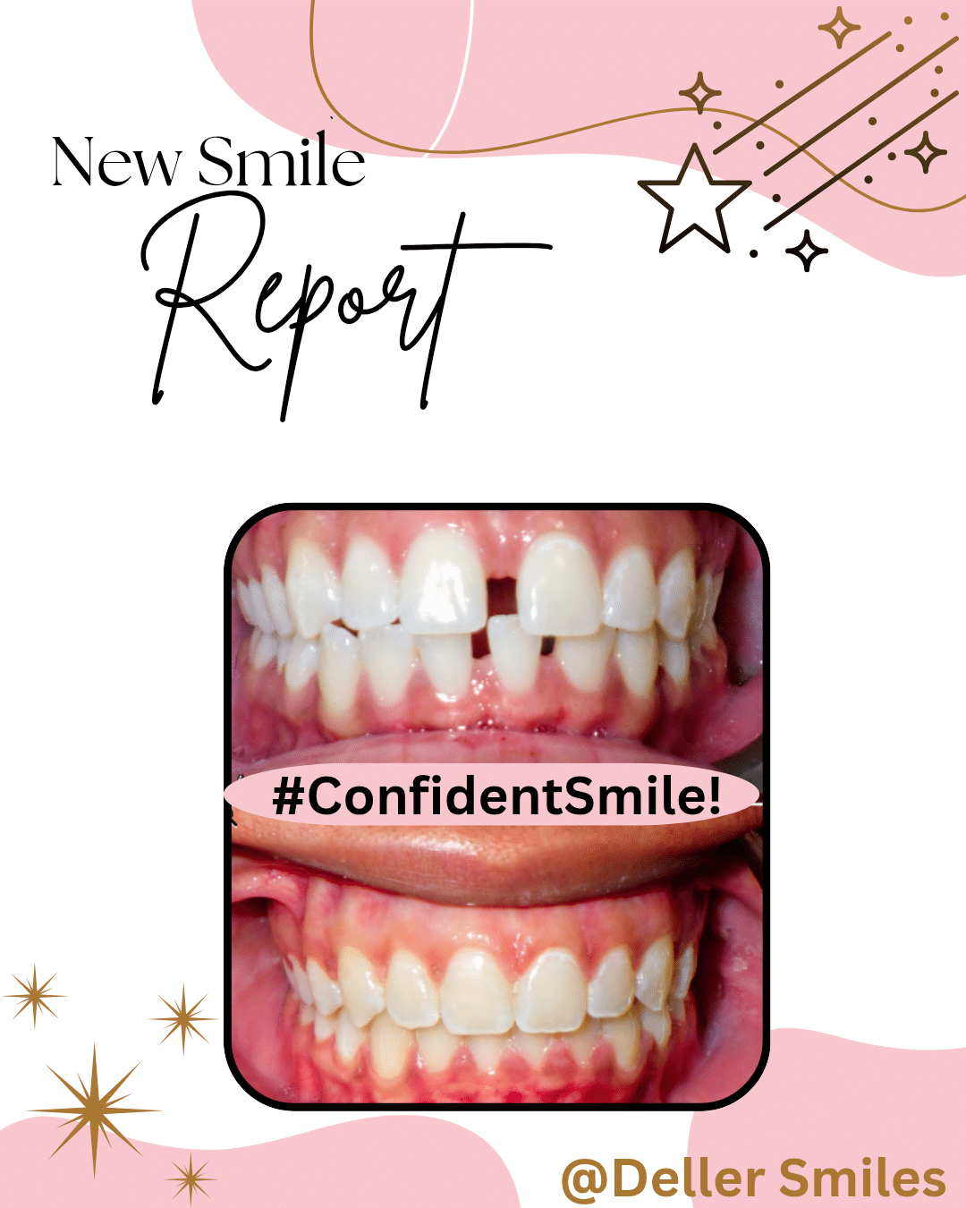 Before and After Orthodontic Treatment Deller Smiles Dental Care & Orthodontics in Rockland, MA