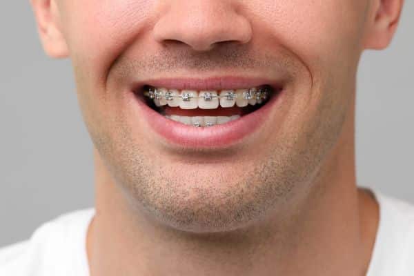 Metal Braces Deller Smiles Dental Care & Orthodontics in Rockland, MA